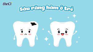 Bé bị sâu răng hàm: Nguyên nhân, dấu hiệu và cách phòng ngừa hiệu quả