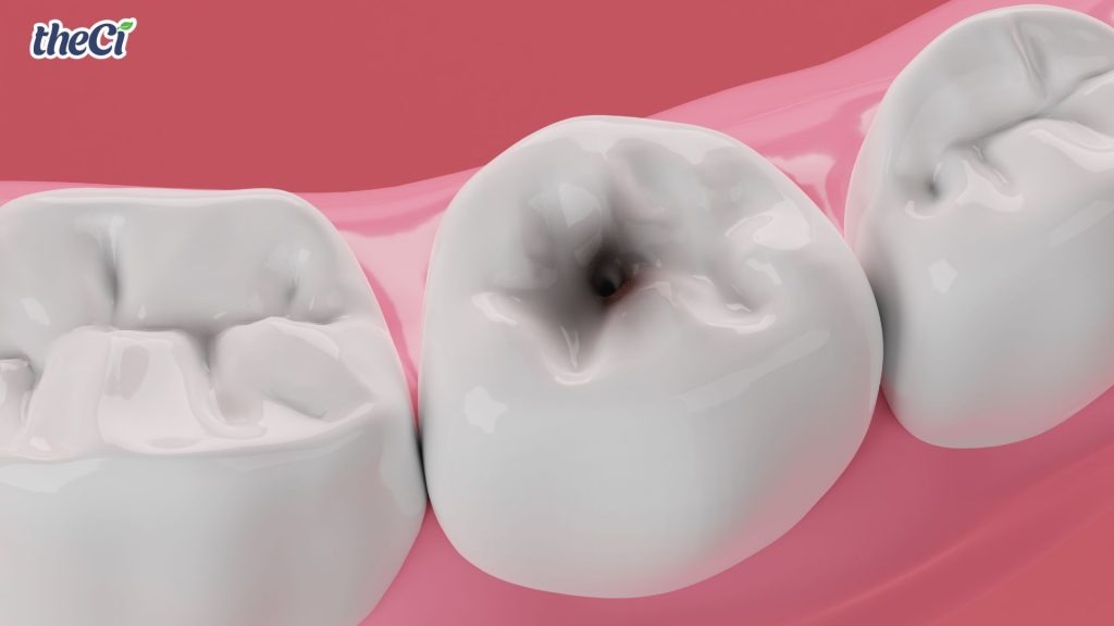 Xịt chống sâu răng theCi - bảo vệ răng miệng cho bé từ sớm 